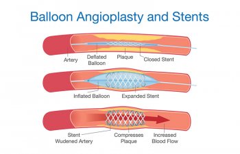 Balloon Angioplasty and Stents