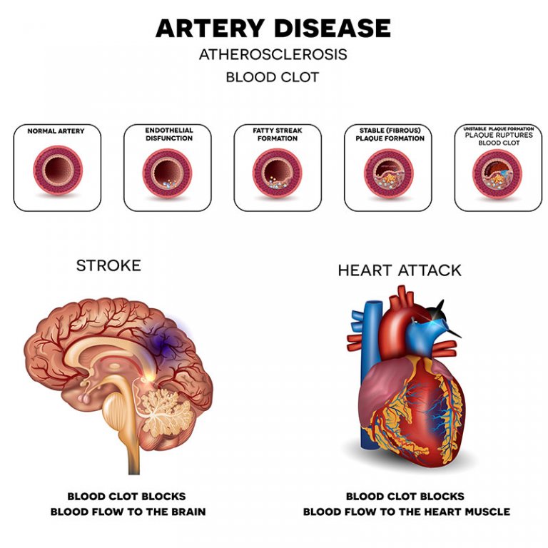 New York Carotid Artery Blockage, Stroke Prevention Procedures NYC