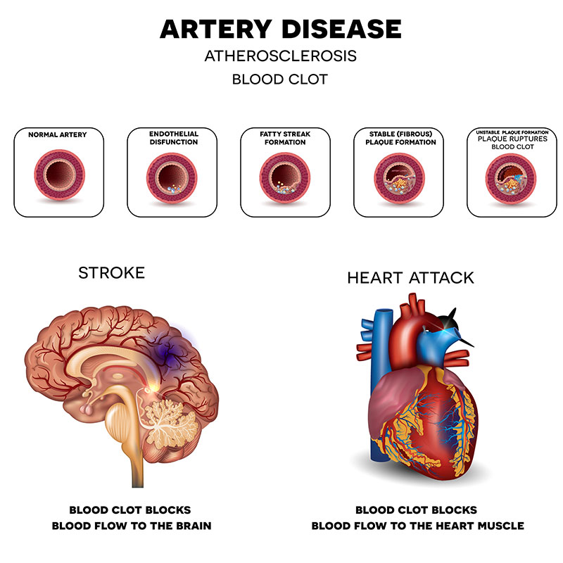 Small arteries, big trouble