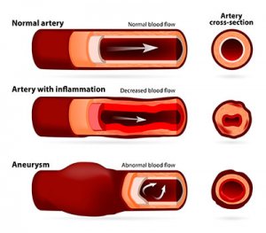 New York NY Treatment for Aortic or Stomach Aneurysm