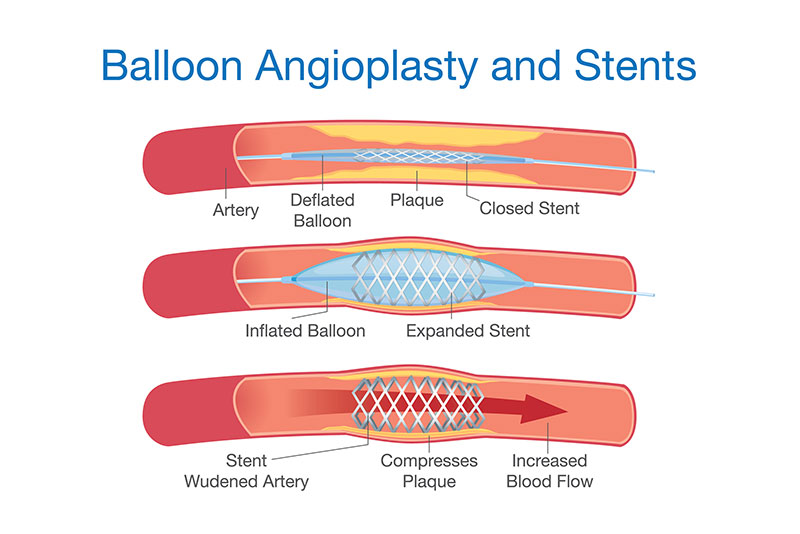 Balloon Angioplasty