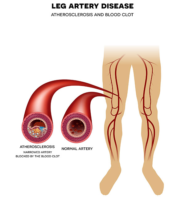 Leg Artery Disease