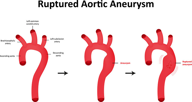 New York NY Ruptured Aortic Aneurysm Treatment
