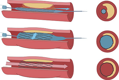 Vascular Stenting