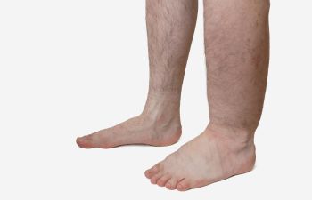 A Closer Look at Chronic Venous Insufficiency: Understanding