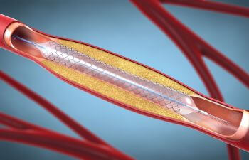 Vascular Stenting